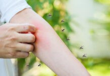 Πώς να ανακουφιστείτε από τσίμπημα κουνουπιού