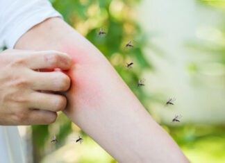 Σας τσίμπησε κουνούπι; Το κόλπο για να σταματήσετε άμεσα τη φαγούρα