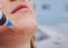 Microneedling: Θεραπεύει το μέλασμα;