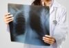 Ετήσιο έλεγχο για καρκίνο του πνεύμονα συνιστά η Αμερικανική Αντικαρκινική Εταιρεία σε όσους καπνίζουν ή κάπνιζαν παλαιότερα